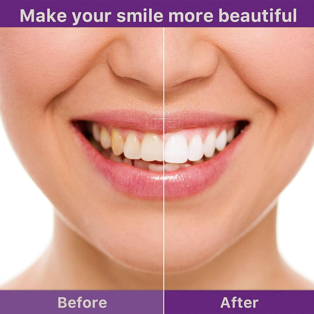 Teeth Whitening at Home